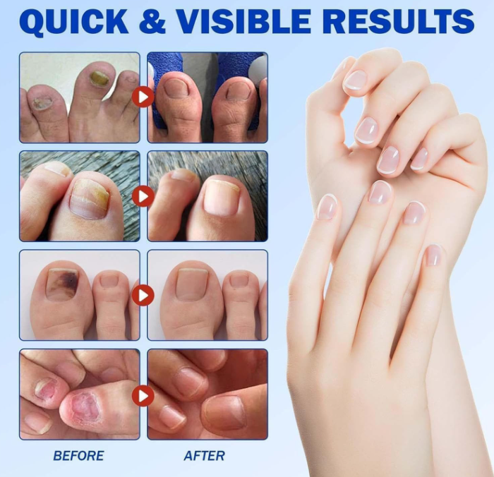 PARCHES PARA HONGOS FUNGAL NAIL X 21