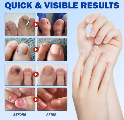 PARCHES PARA HONGOS FUNGAL NAIL X 21